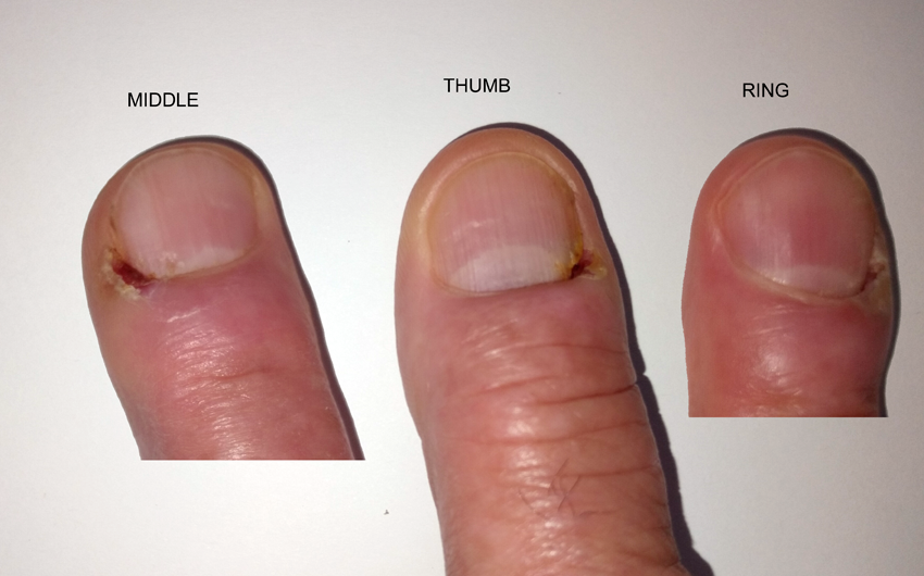 Fingers x2 & Thumb (RH)_2023.png